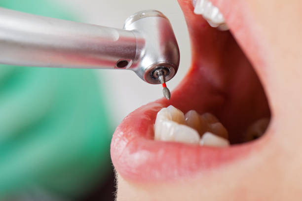Best Emergency Dentist for Knocked-Out Tooth in Level Plains, AL